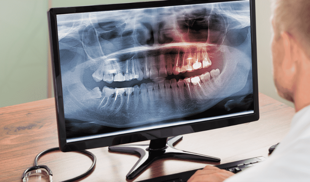 What you need to know before getting a root canal treatment