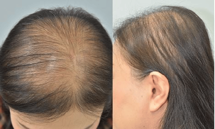 What Does 100 Strands of Hair Loss Look Like?