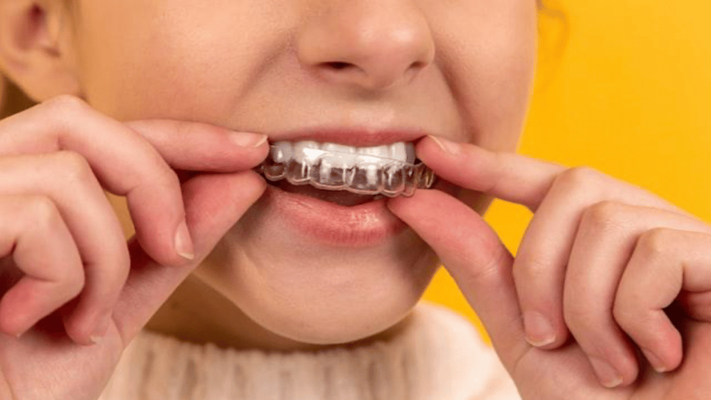 What is the Purpose of the Attachments in the Impress clear Aligners Treatment?