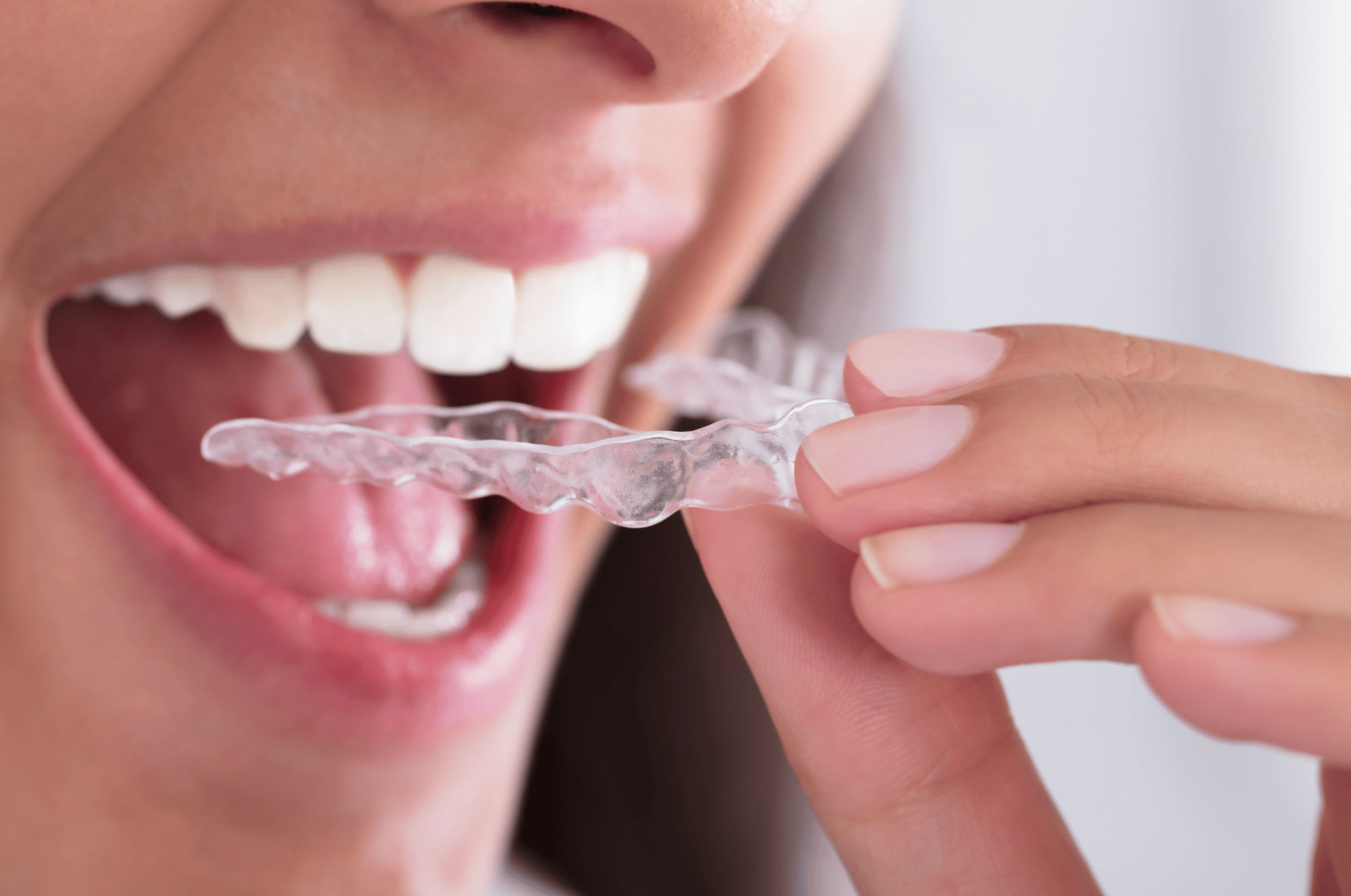 Сильно сжатые зубы. Аксессуары для Invisalign. Ночная Каппа на зубы.