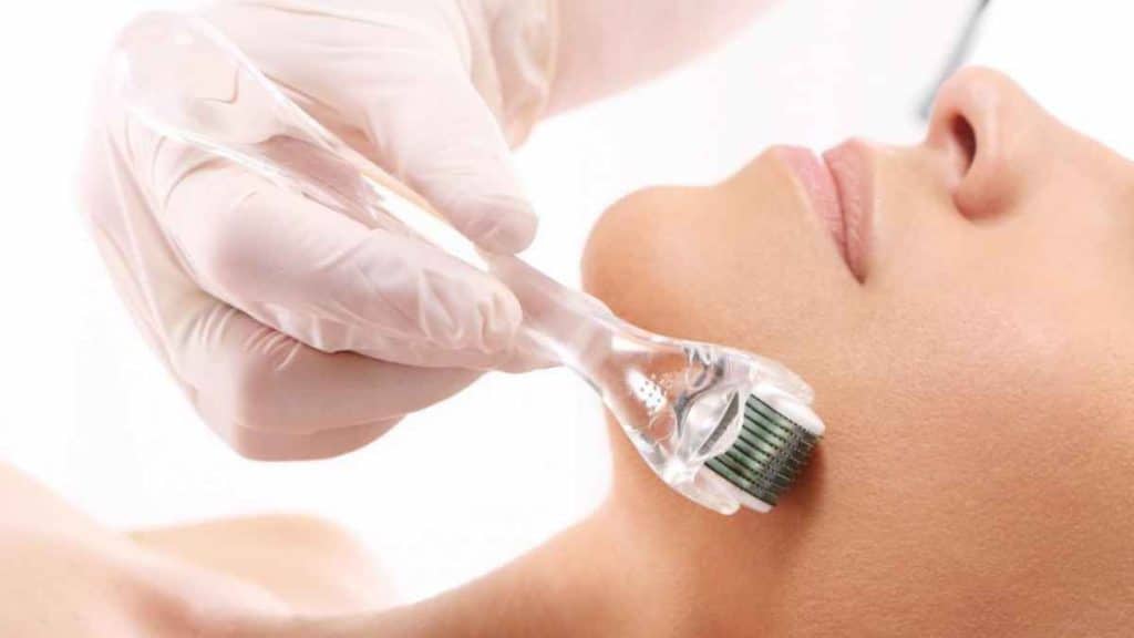 How does Microneedling help Create Smooth, Youthful-looking Skin?