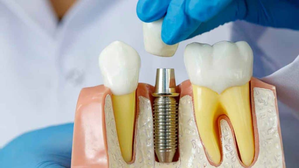 The Correlation Between Dental Implants And Oral Health