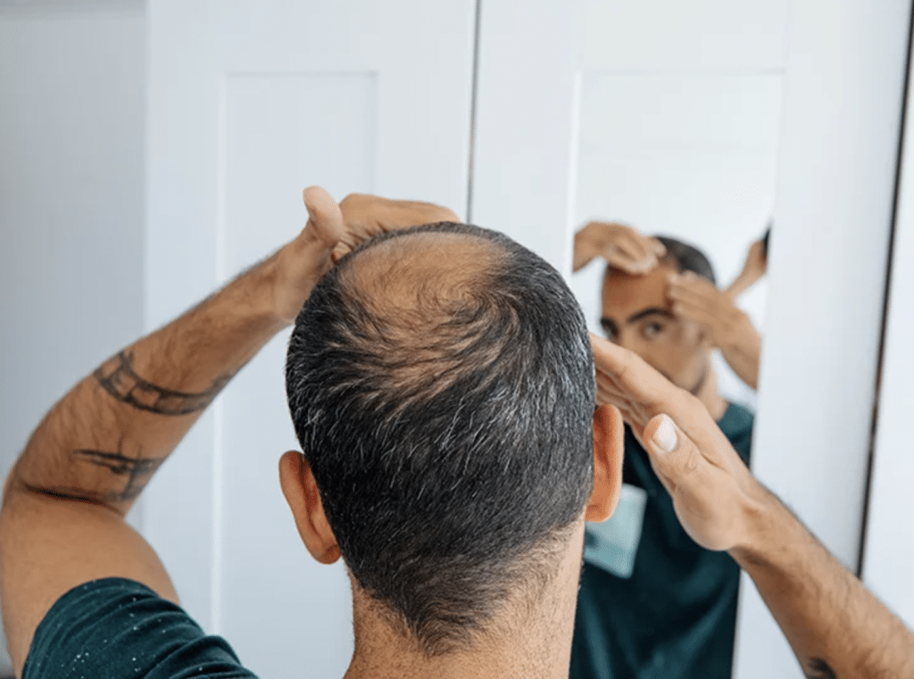 Finasteride: Does it help hair grow back?