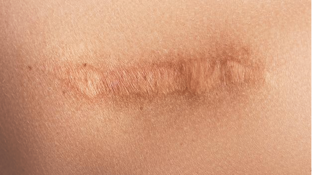 How to Prevent Scarring? Wound Care Matters!
