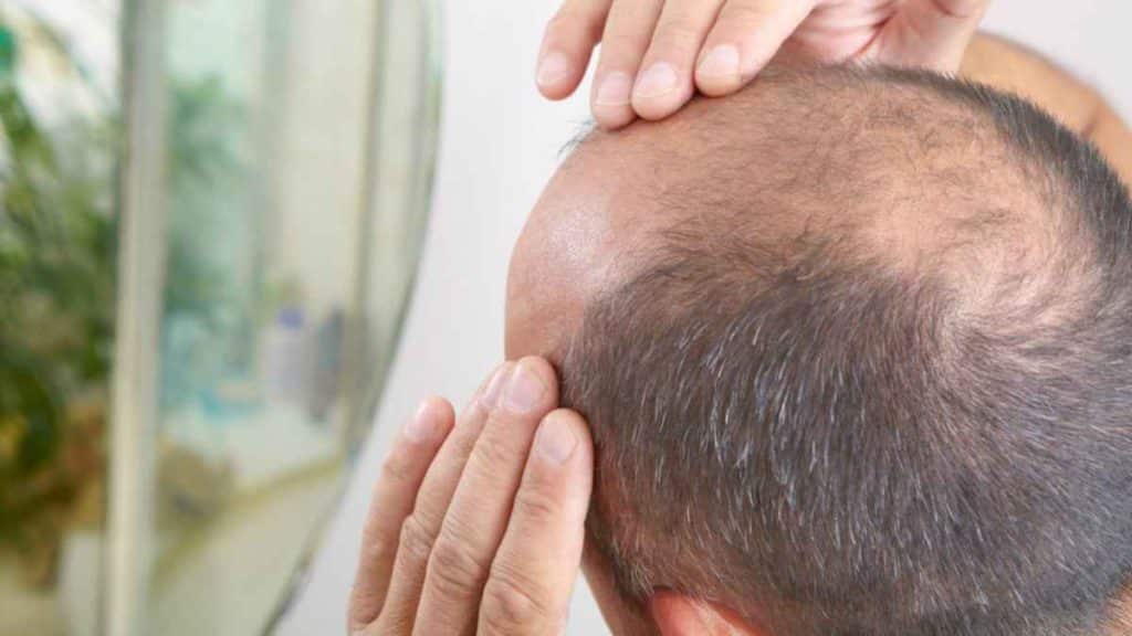 Sons IE - Minoxidil Will it solve my hair loss problem?