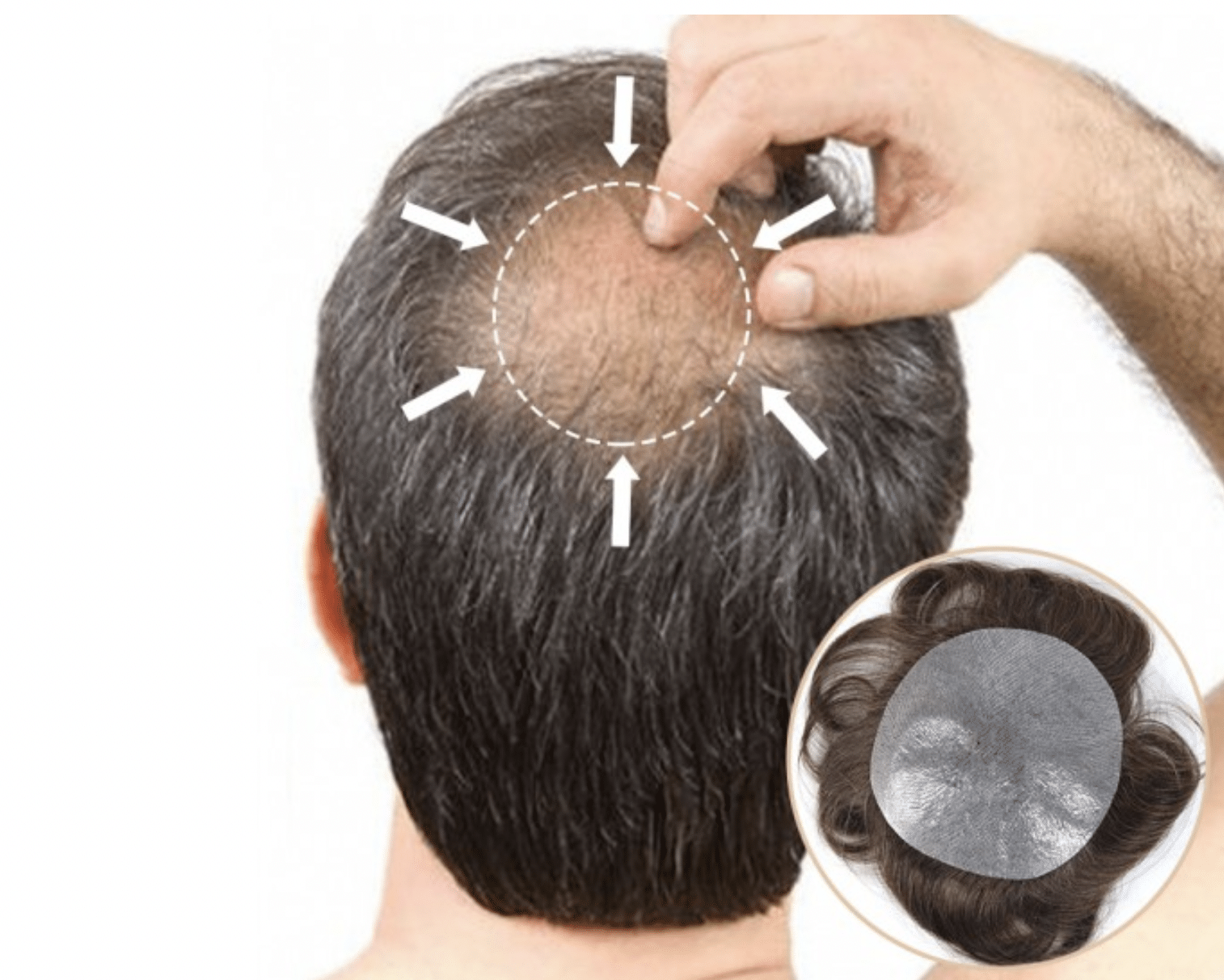 Hair Patch for Men Cost, Durability, and Longevity Explained