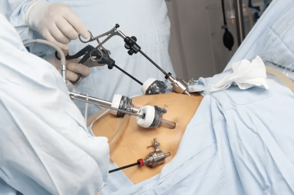 Understanding Bariatric Surgery: Types and Benefits