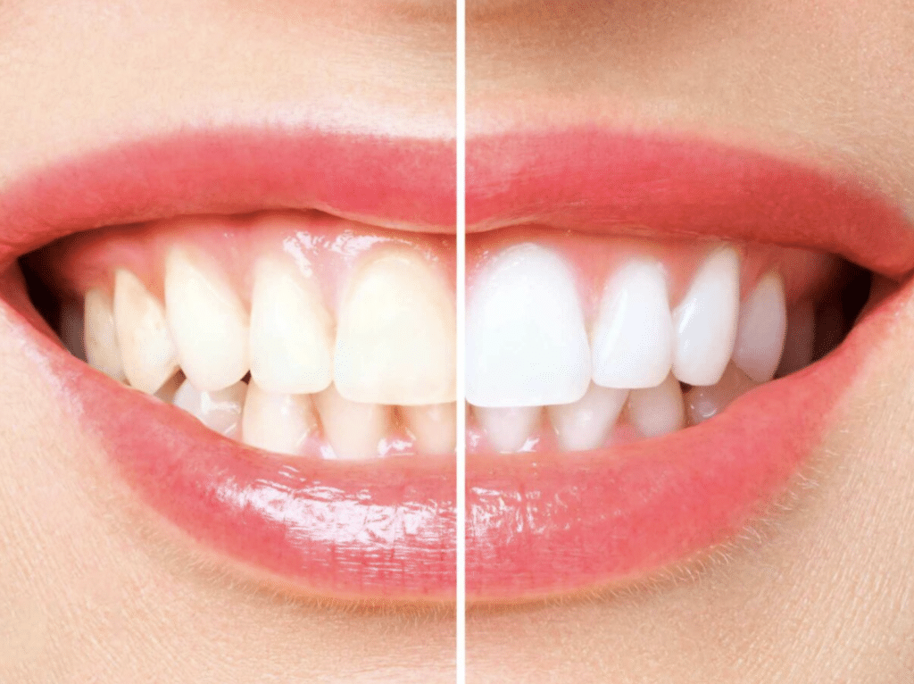 Unveiling the Reality of Teeth Whitening: Effective Strategies vs. Myths
