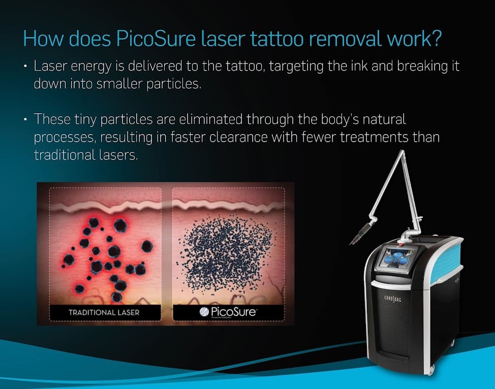 PicoSure Revolution