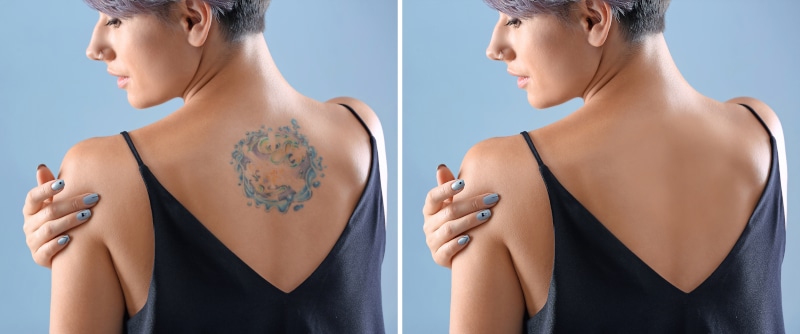 Tattoo Removal