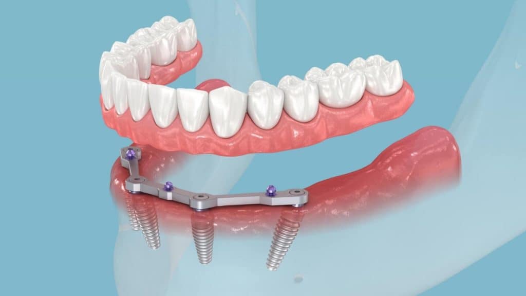 All-On-Four Dental Implants A Comprehensive Guide for patients