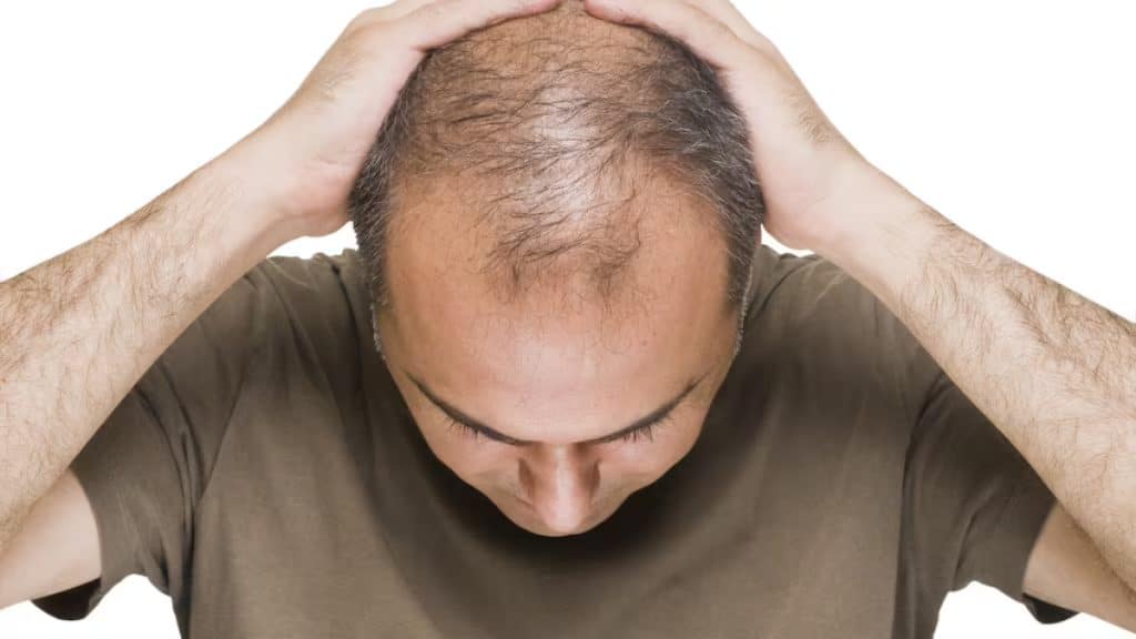 Sons IE - Explaining Hair Loss Everything You Need to Know