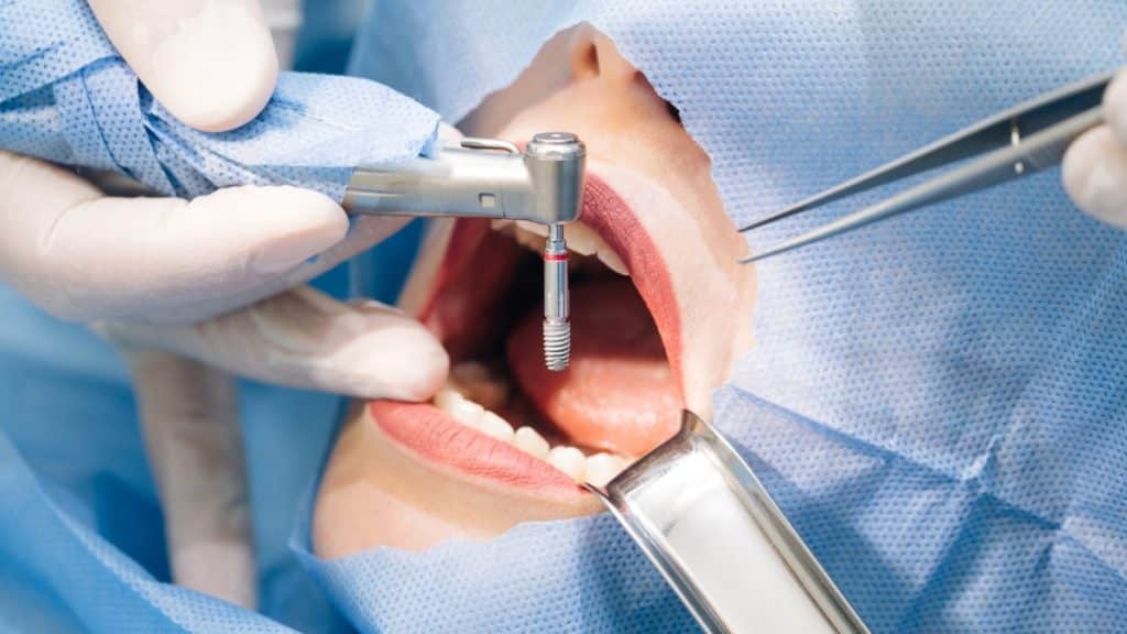 2025’s Best Countries for Dental Implants Cost, Quality, and Expert Care