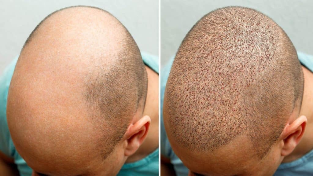 An In-Depth Overview of FUE Hair Transplant in Colombia
