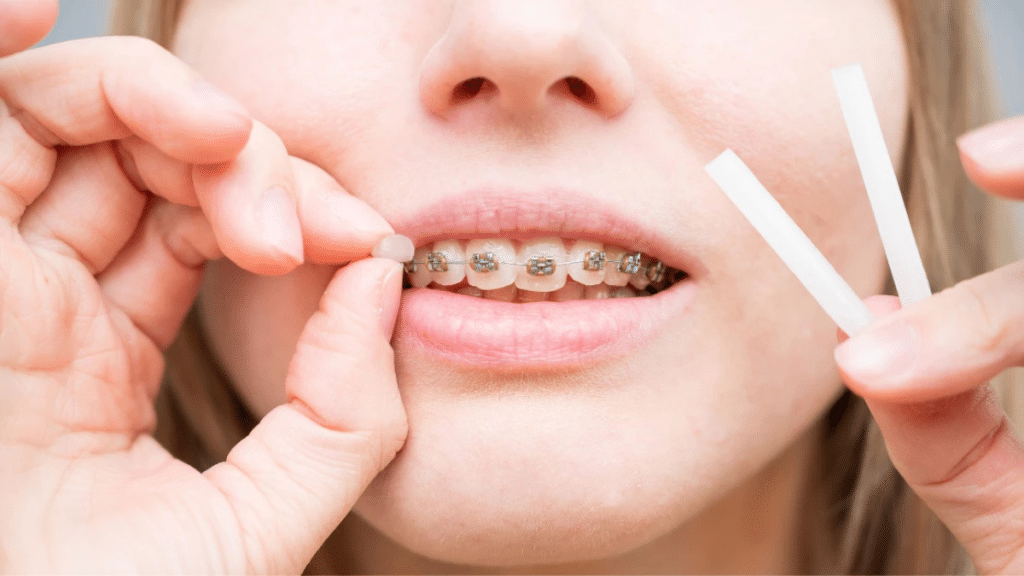 Benefits of Using Orthodontic Wax