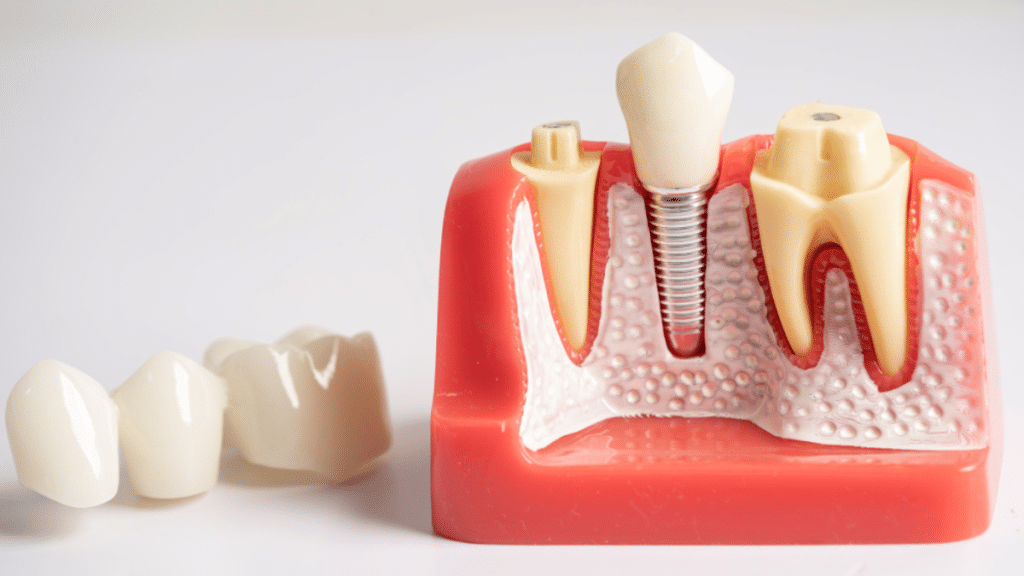 A Step-by-Step Guide to the Dental Implant Process for Leawood Residents