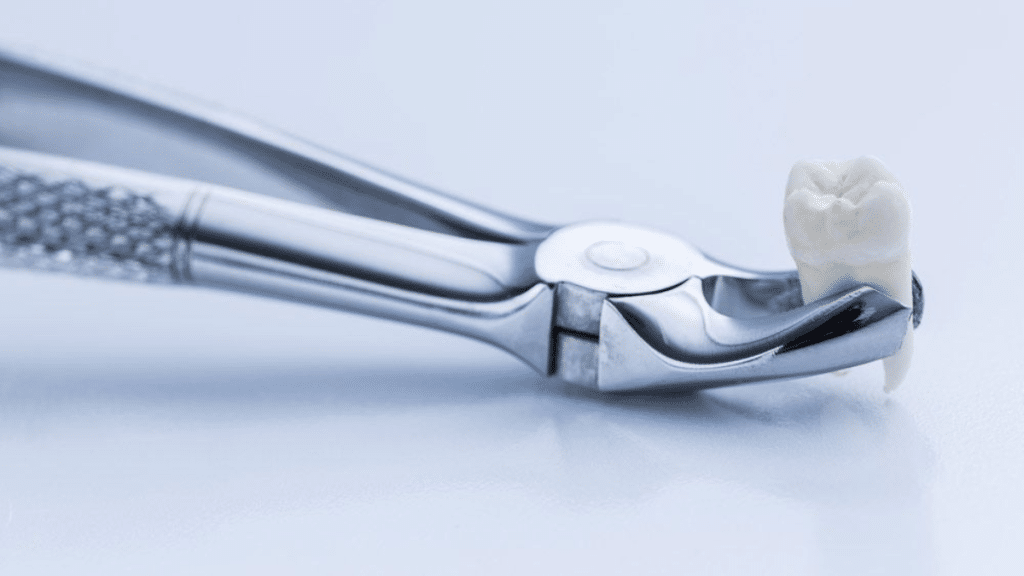 Before You Decide What to Expect from Wisdom Tooth Extraction in Las Vegas