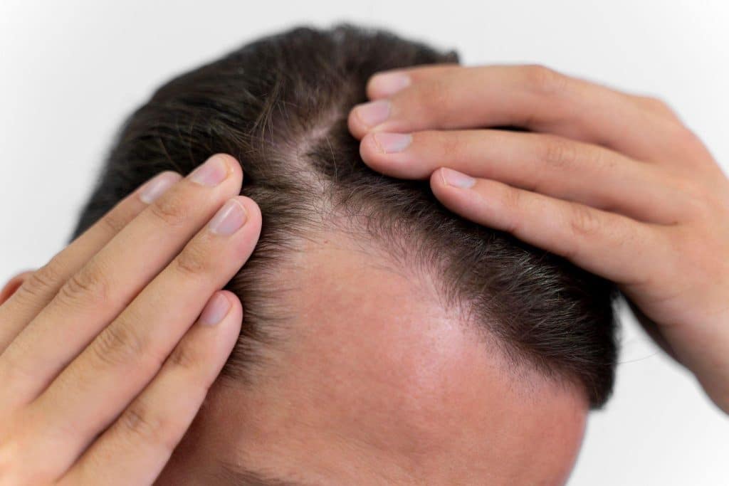 Image 1 of A Beginner's Guide to Identifying Early Signs of Balding